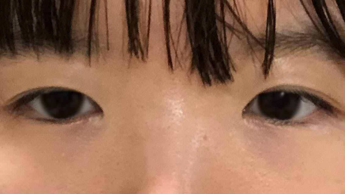 千川形成外科で眼瞼下垂を受けたしめじさんの写真