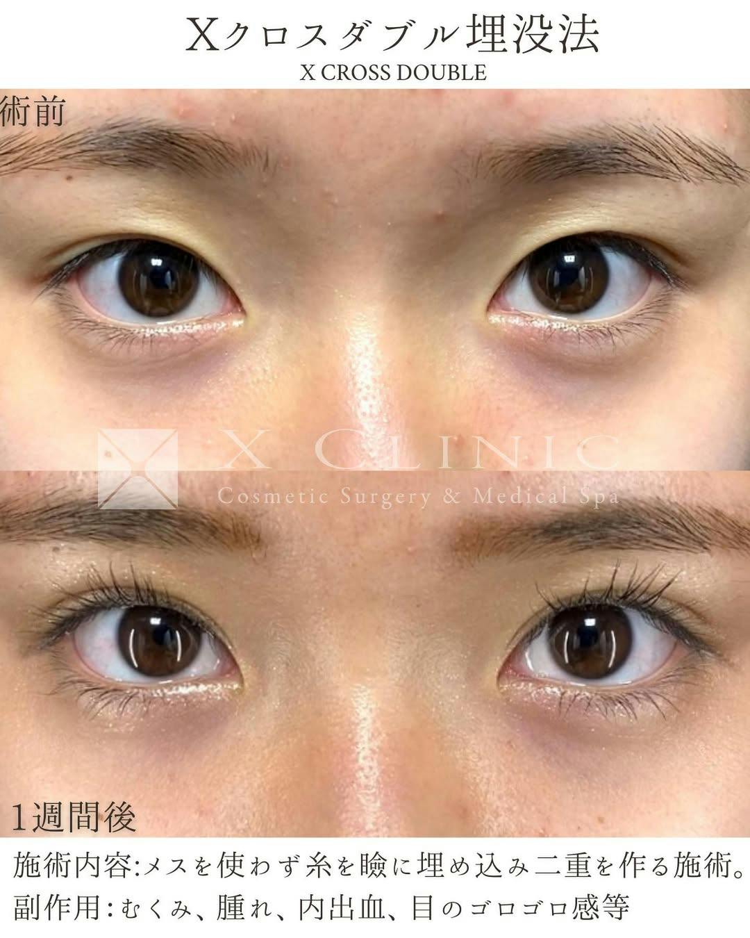 【女性・目元】×クロスダブル埋没法_before_aftar