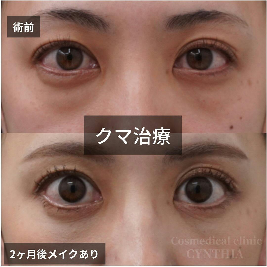 【30代女性・目元】目の下のクマ・たるみ取り_before_aftar