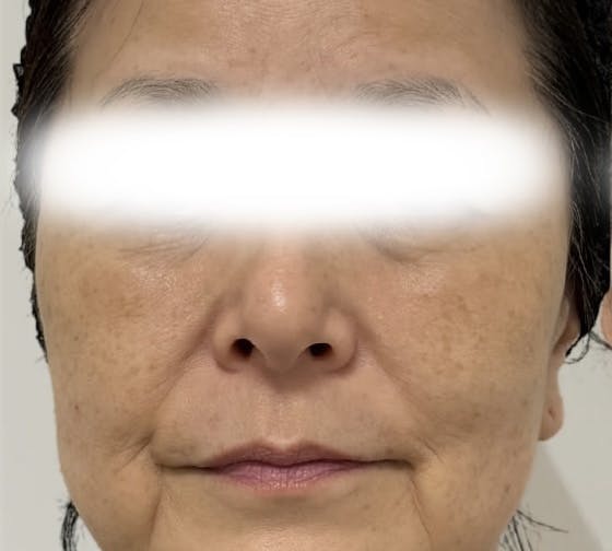 【60代女性・ほうれい線】ヒアルロン酸_b1