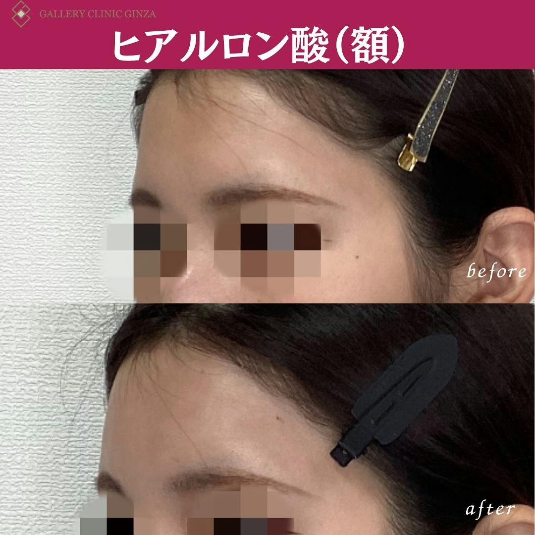 【女性・額】ヒアルロン酸(額)_before_aftar