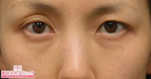 【女性・目元】目の下の切らないクマ・たるみ（ふくらみ）取り ナチュラル脂肪注射コンデンスリッチ ナチュラル脂肪注射ナノリッチ_before