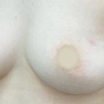 【女性・胸】Aquicell(アキーセル)併用コンデンスリッチ(脂肪注入豊胸) コールマン式_before