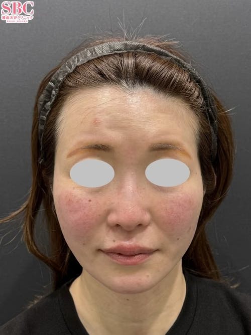 【40代女性・たるみ】メーラーファット除去術_before