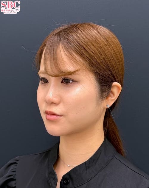 【20代女性・顔・頬・顎下】小顔用脂肪吸引注射(頬・ジョールファット・顎下)・エンブレイスRF・プリマリフト_after