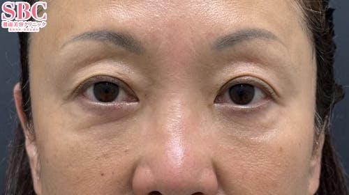 【50代女性・たるみ】目の下の切らないクマ・たるみ（ふくらみ）取り ナチュラル脂肪注射コンデンスリッチ ナチュラル脂肪注射ナノリッチ_after