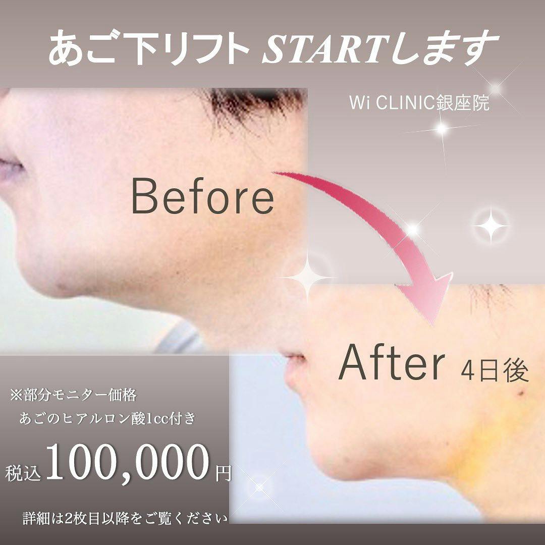 【女性・顎下】あご下糸リフト_before_aftar