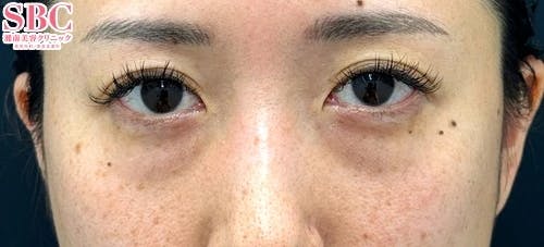 【30代女性】目の下の切らないクマ・たるみ(ふくらみ)取り・ナチュラル脂肪注射ナノリッチ・コンデンスリッチ_before