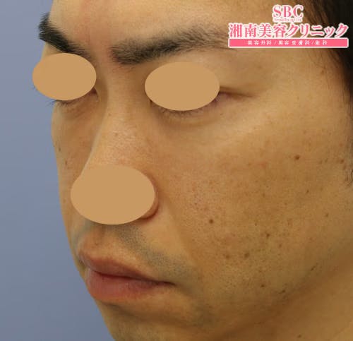 【男性・輪郭】ナチュラル脂肪注射コンデンスリッチ、シークレットリフト_aftar