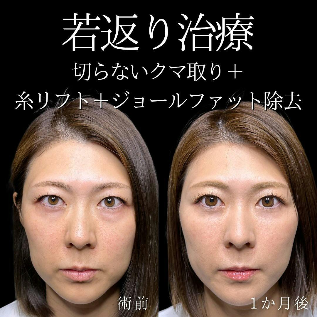 【女性・目元・顔】切らないクマ取り・糸リフト・ジョールファット除去_before_aftar
