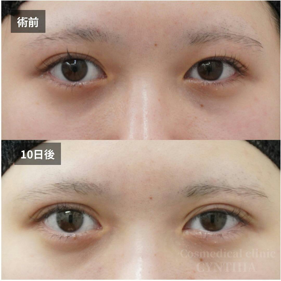 【20代女性・目元】二重埋没法_before_aftar