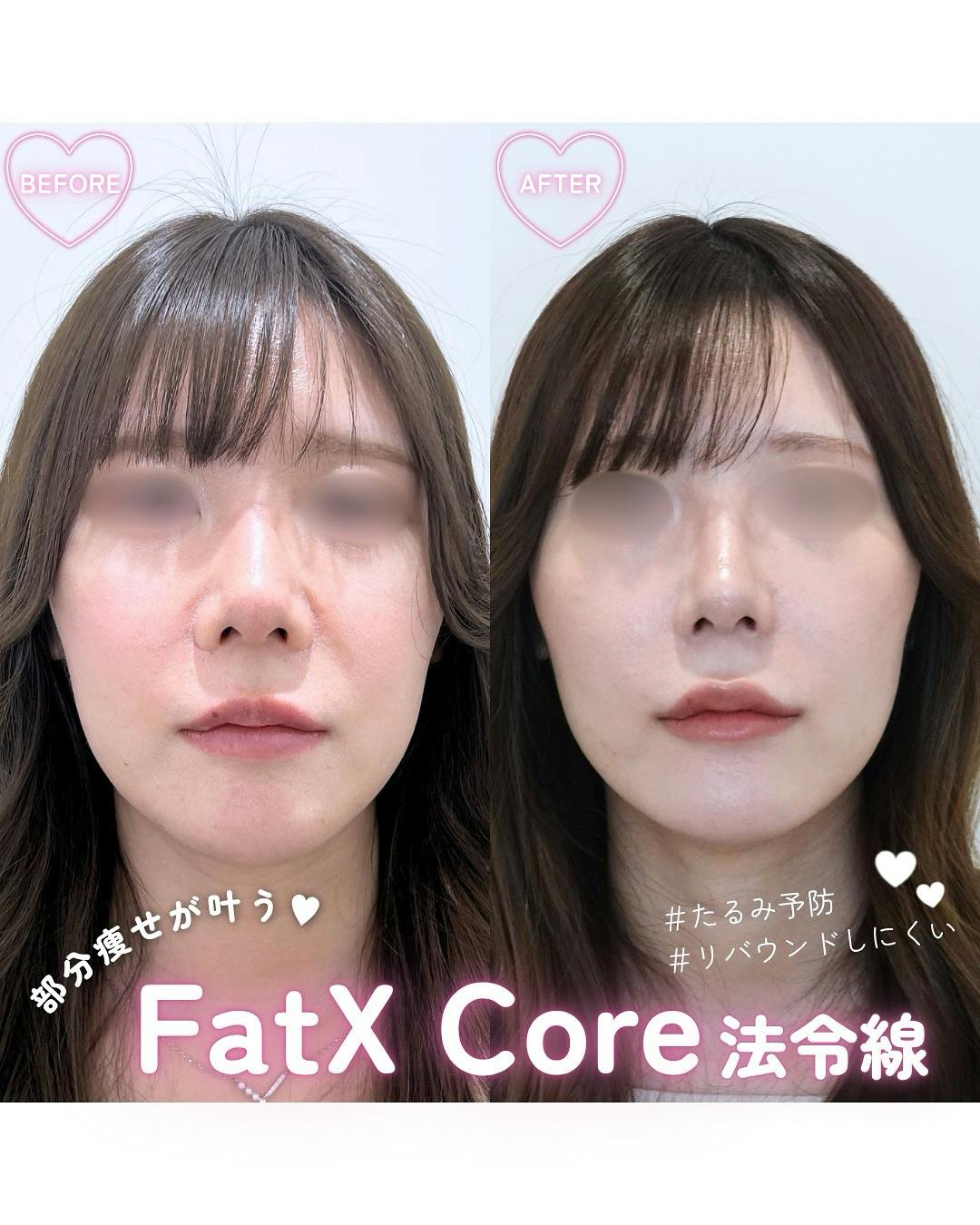 【女性・顔】FatX core 法令線_before_aftar