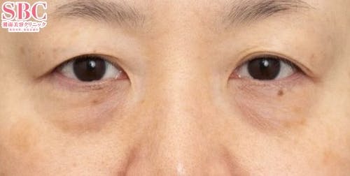 【50代女性・目元】目の下の切らないクマ・たるみ（ふくらみ）取り、ナチュラル脂肪注射コンデンスリッチ、ナチュラル脂肪注射ナノリッチ、VOVリフト_before