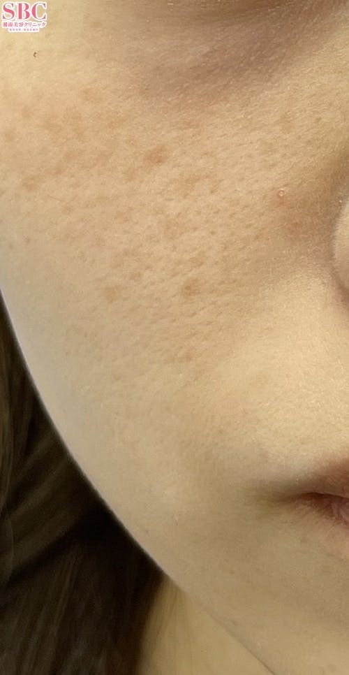 【女性・顔】ブラックピール_after