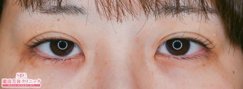 【女性・目元】クイックコスメティーク・シングルNeo、クイックコスメティーク・ダブルNeo_justbefore