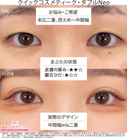 【女性・目元】クイックコスメティーク・ダブルNeo_before_aftar