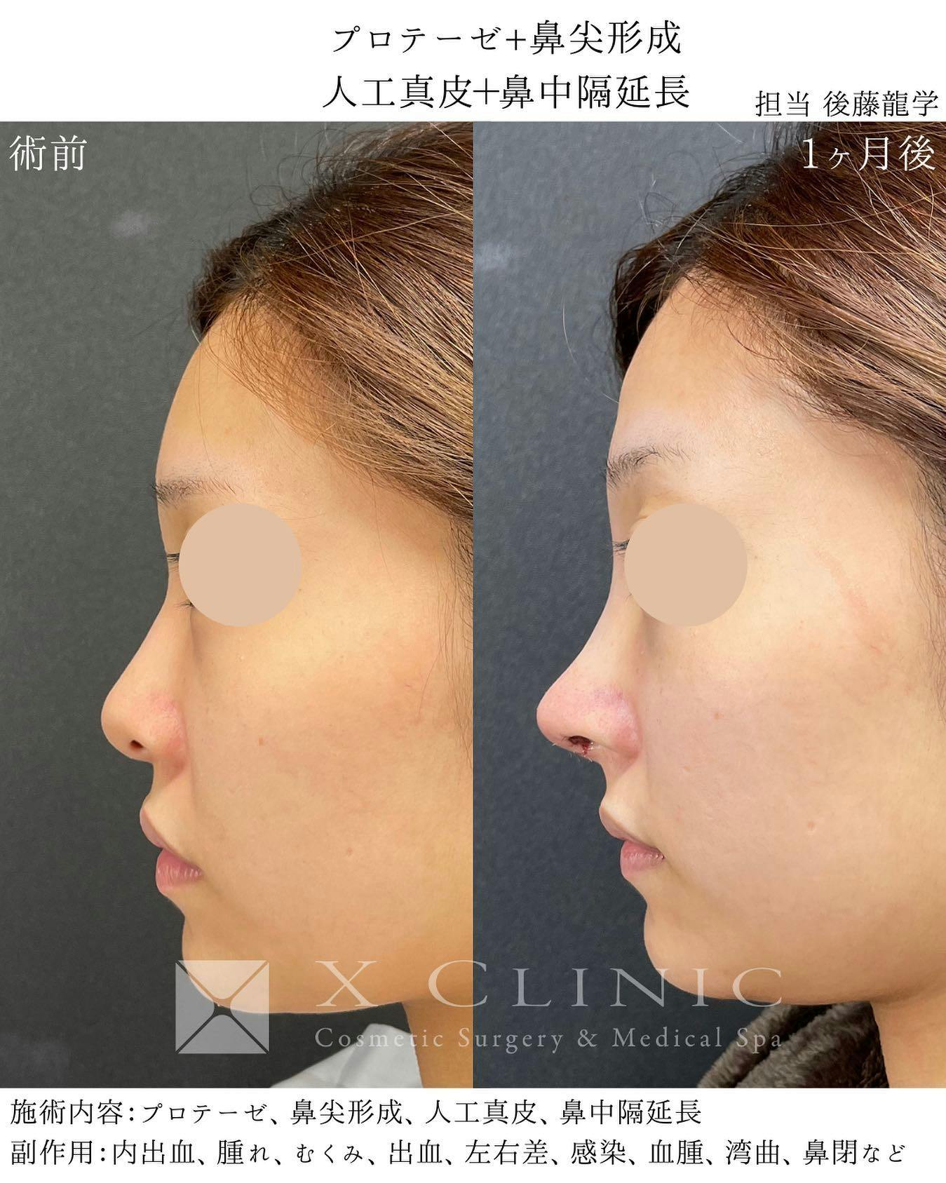 【女性・鼻】定額鼻整形（プロテーゼ、鼻尖形成、人工真皮、鼻中隔延長）_before_aftar