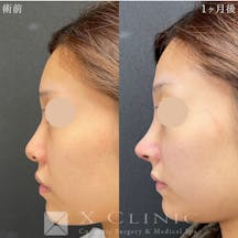 【女性・鼻】定額鼻整形(プロテーゼ、鼻尖形成、人工真皮、鼻中隔延長)_before_aftar