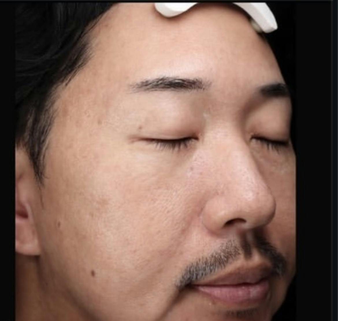 【男性・赤み鎮静】リジュメソ_a1