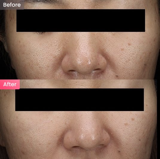 【女性・毛穴】頬とこめかみの毛穴凹凸が気になるの写真