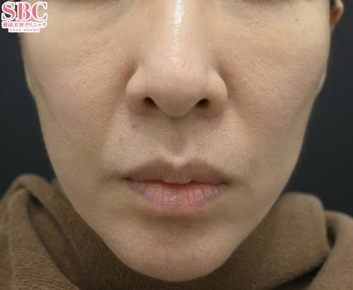 【女性・顔】シルファームX・プロファイロ_after