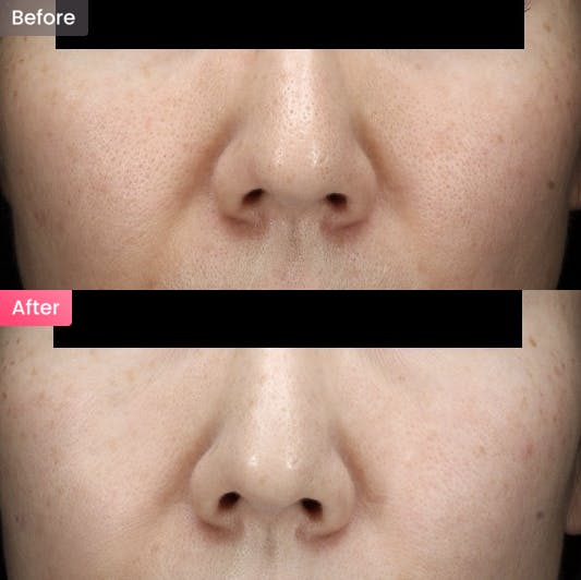 【女性・毛穴】毛穴の開きが気になるの写真