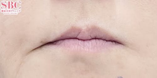 【40代女性・唇】コンデンスリッチフェイス脂肪注入全顔入れ放題_before