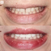 【女性・歯】1dayスピードセラミック 矯正_before_aftar