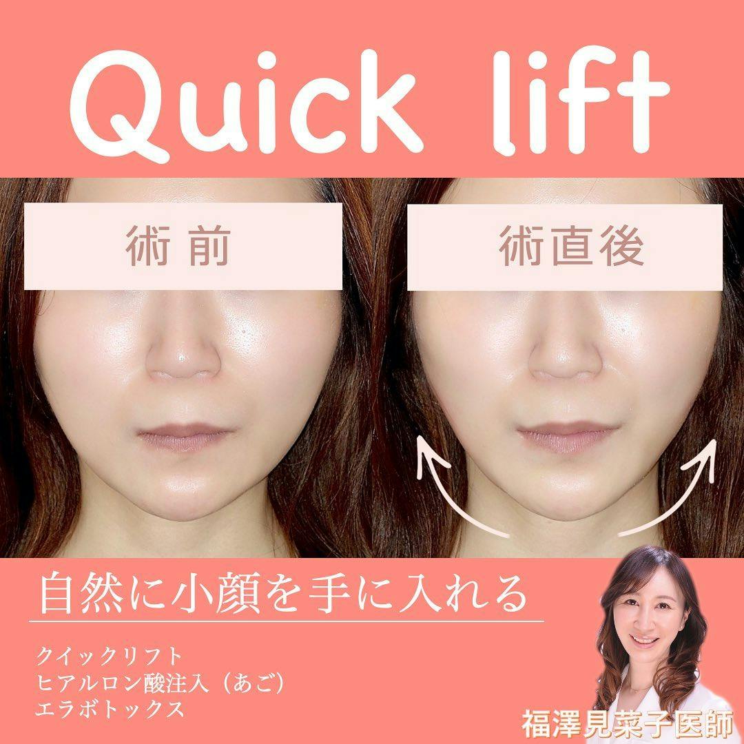 【女性・小顔】クイックリフト_before_aftar