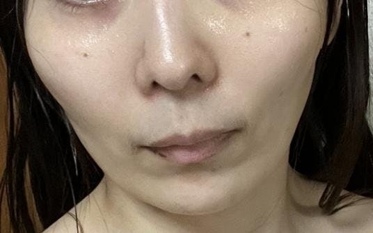 よつば会クリニック 栄・矢場町院でVビームを受けたayaさんの写真