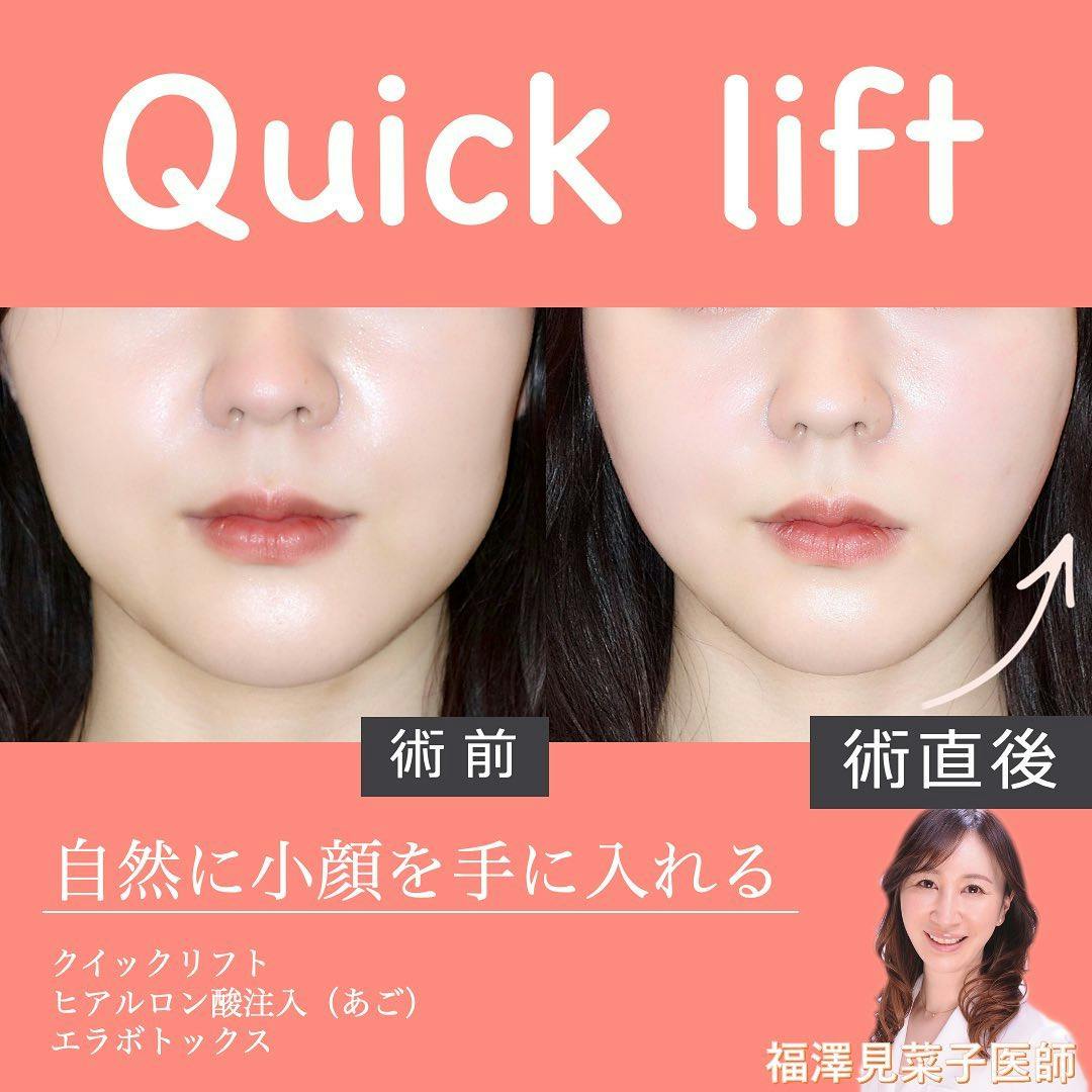 【女性・たるみ】クイックリフト、エラボトックス_before_aftar