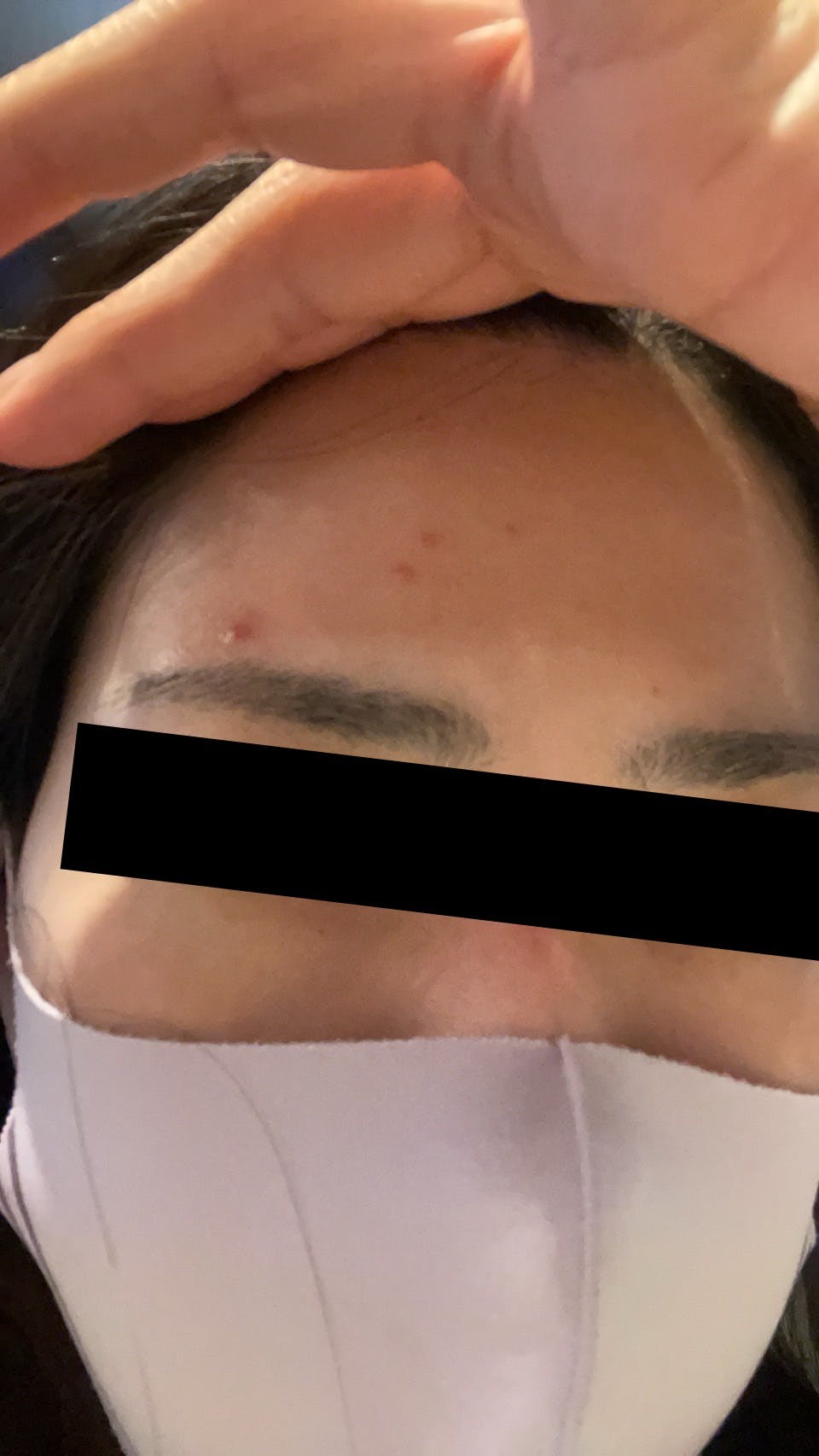 青山ヒフ科クリニックでを受けたかぼさんの写真