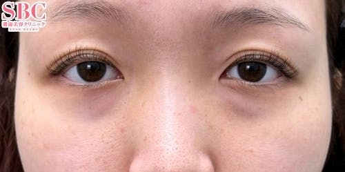 【30代女性・目元】裏ハムラ法、ナチュラル脂肪注射ナノリッチ_before