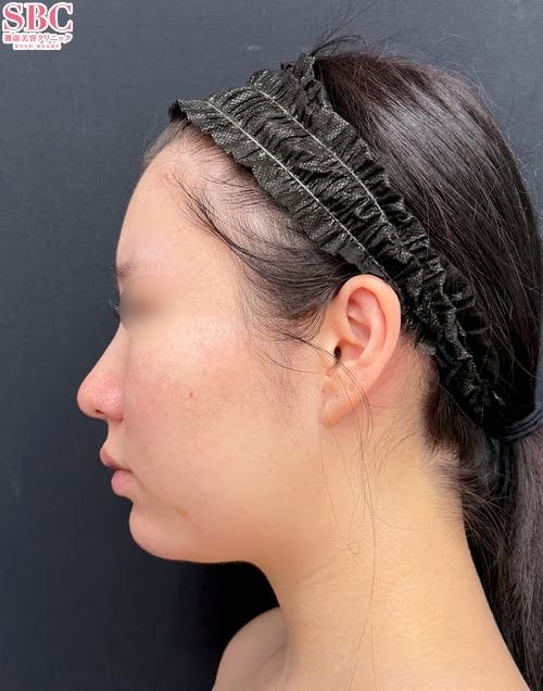 【20代女性・顔・頬・顎下】メーラーファット除去術・Aquicell(アキーセル)脂肪吸引・根こそぎVASER脂肪吸引_before