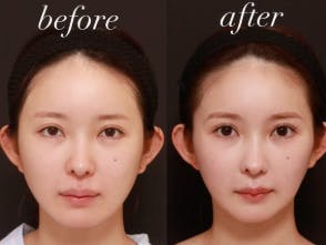 【女性・顎】上下顎骨切り術_before_aftar