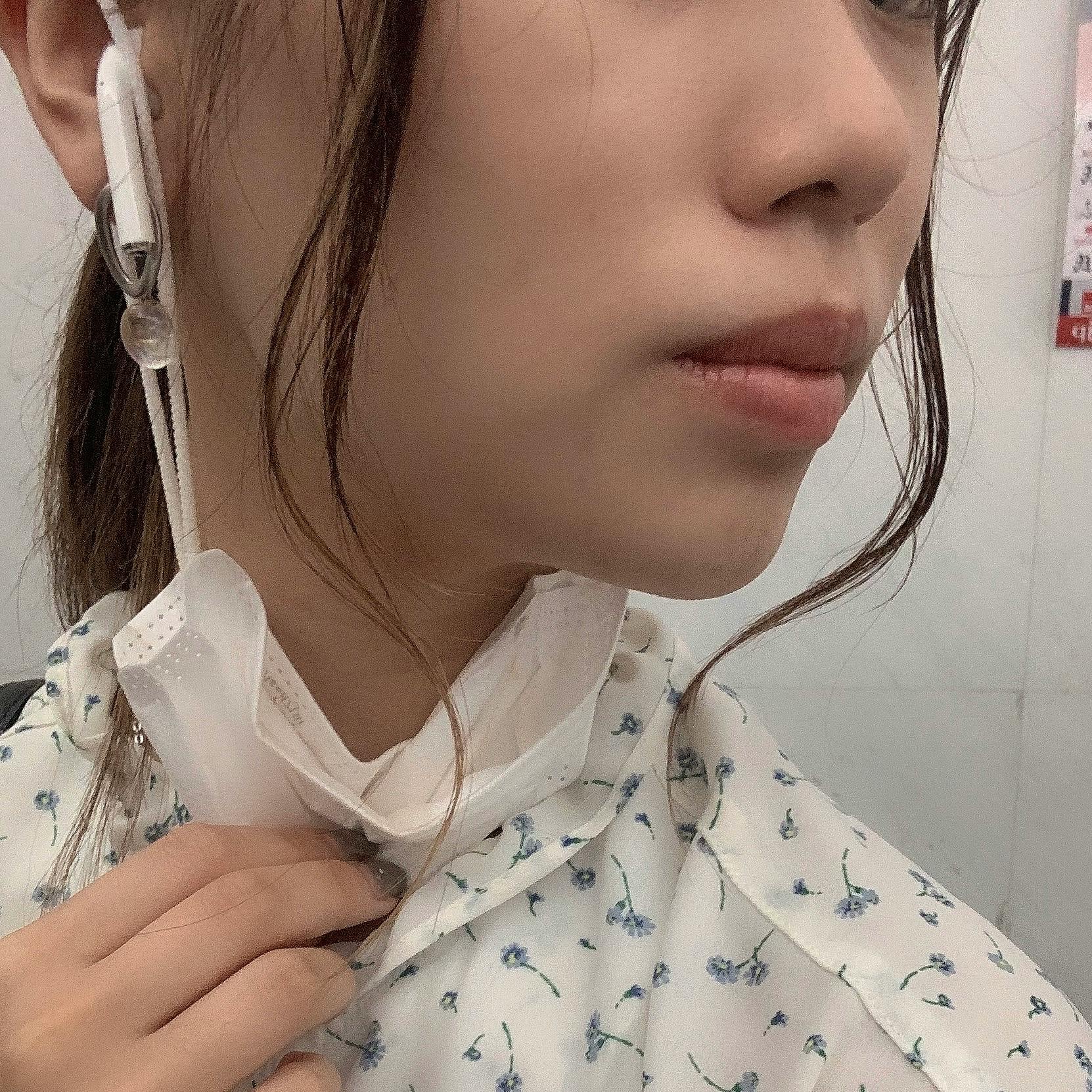 品川美容外科 横浜院（※品川スキンクリニック提携）でを受けたminaさんの写真