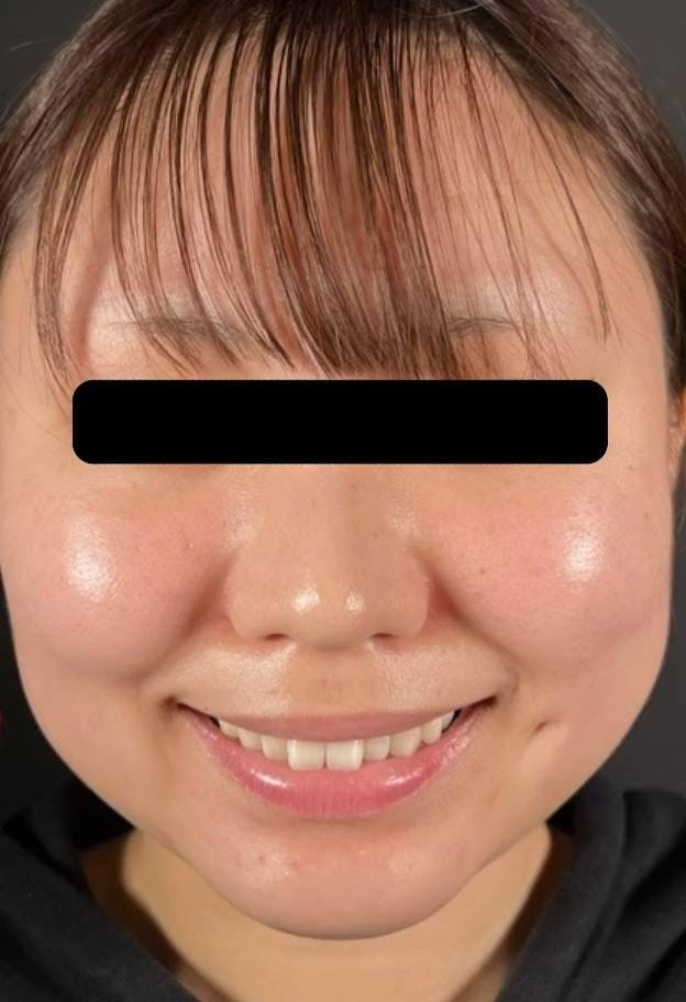 ワムクリニック銀座(WOM CLINIC GINZA)でメーラーファット除去:メーラーファット除去を受けたりんご飴さんの写真