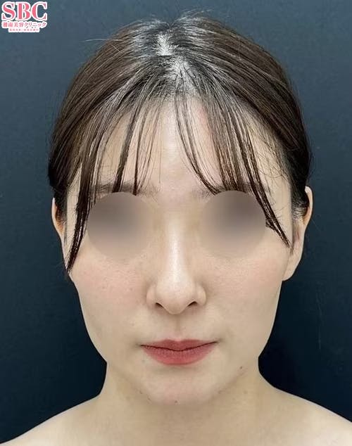 【20代女性】小顔用脂肪吸引注射・バッカルファット除去・糸リフト・その他の治療法_after