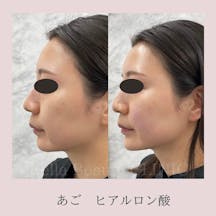【女性・顎】ヒアルロン酸(顎)_before_aftar