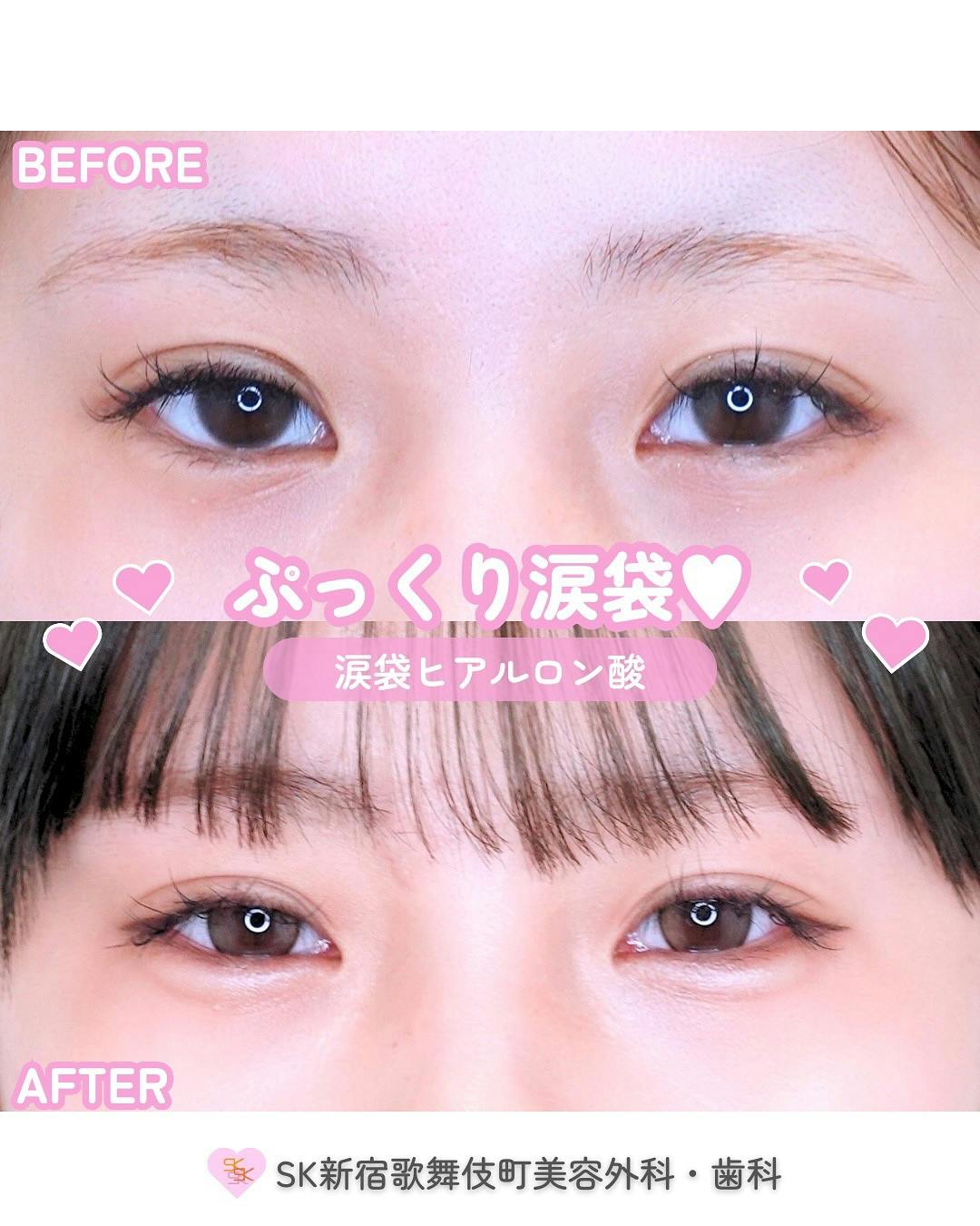 【女性・目元】涙袋ヒアルロン酸_before_aftar