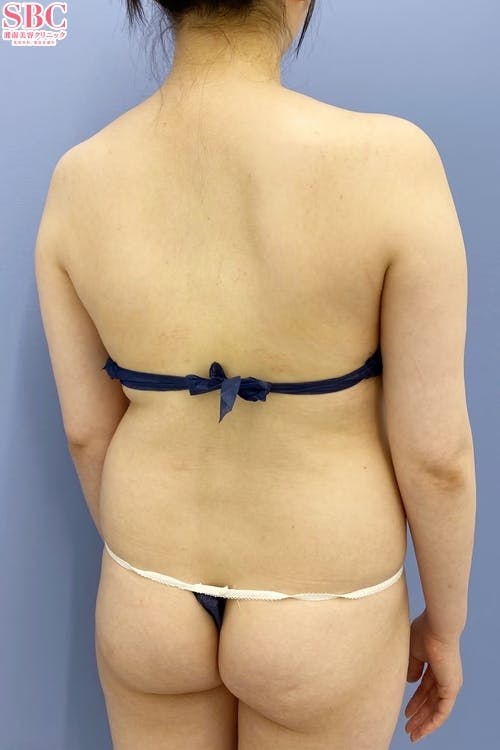 【女性・上半身】Aquicell（アキーセル）脂肪吸引、根こそぎVASER脂肪吸引_before