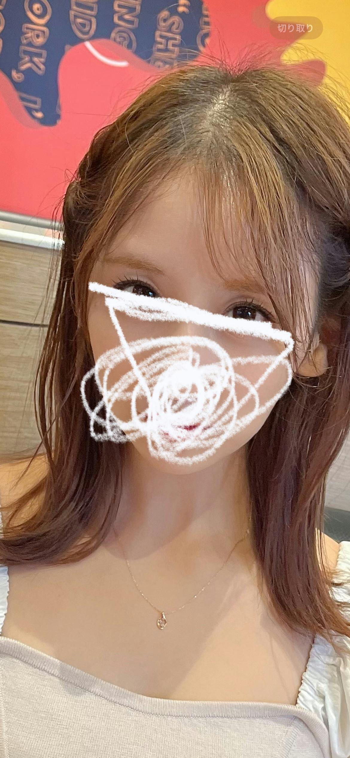 蘇春堂形成外科で眼瞼下垂手術を受けたelleriさんの写真