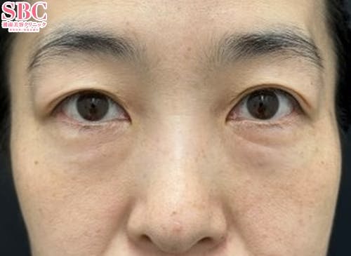 【女性・たるみ】目の下の切らないクマ・たるみ（ふくらみ）取り・ナチュラル脂肪注射コンデンスリッチ_before