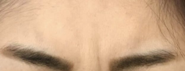 さわこ形成外科クリニックでボトックスを受けたMさんの写真