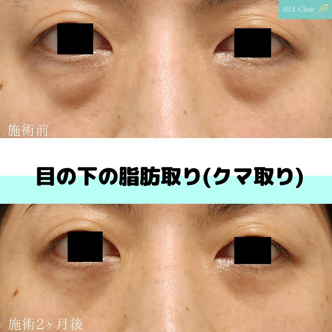 【クマ】目の下の脂肪取り(クマ取り)_before_aftar