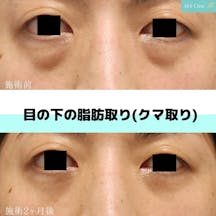 【クマ】目の下の脂肪取り(クマ取り)_before_aftar