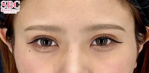 【女性・目元】週末二重(R)_aftar