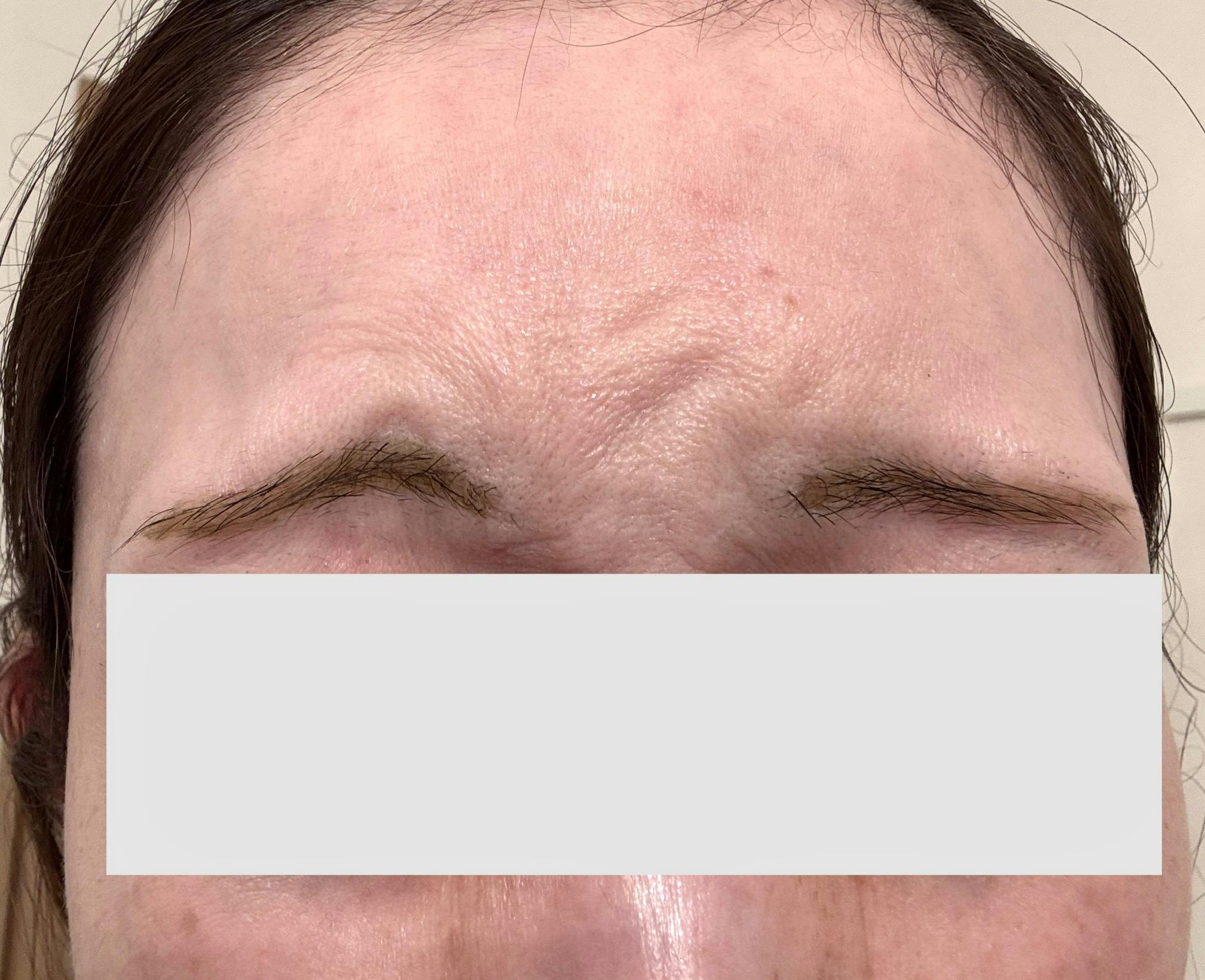 ゼティスビューティークリニック 新宿院(Zetith Beauty Clinic)でを受けたarai03さんの写真