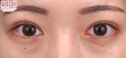 【20代女性・目元】クイックコスメティーク・トリプルNeo_after