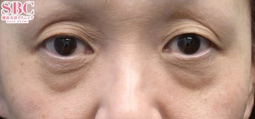 【女性・目元】目の下の切らないクマ・たるみ（ふくらみ）取り、ナチュラル脂肪注射コンデンスリッチ、ナチュラル脂肪注射ナノリッチ_before